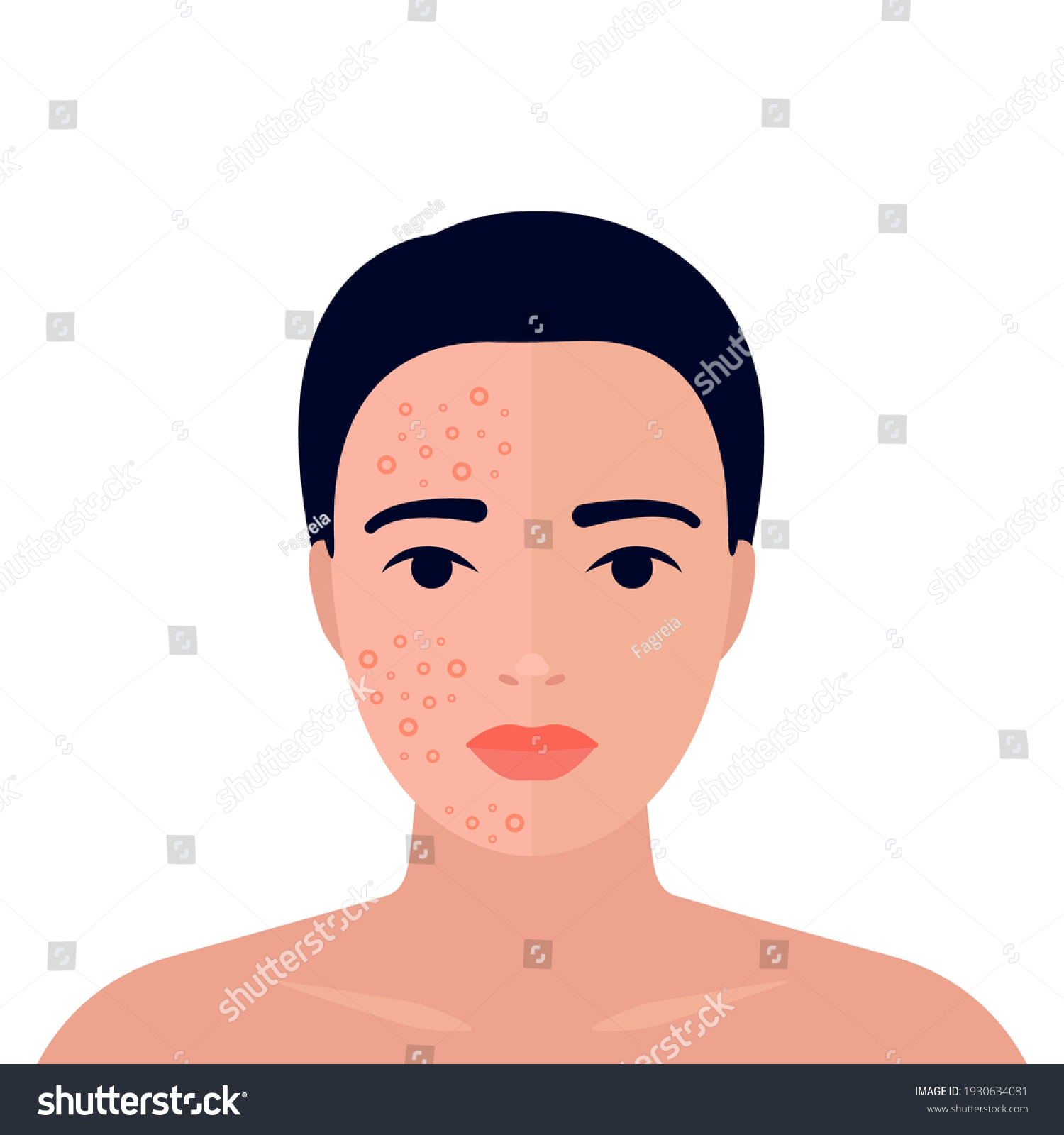 Woman Before After Acne On Skin Stock Vector (Royalty Free) 1930634081 ...