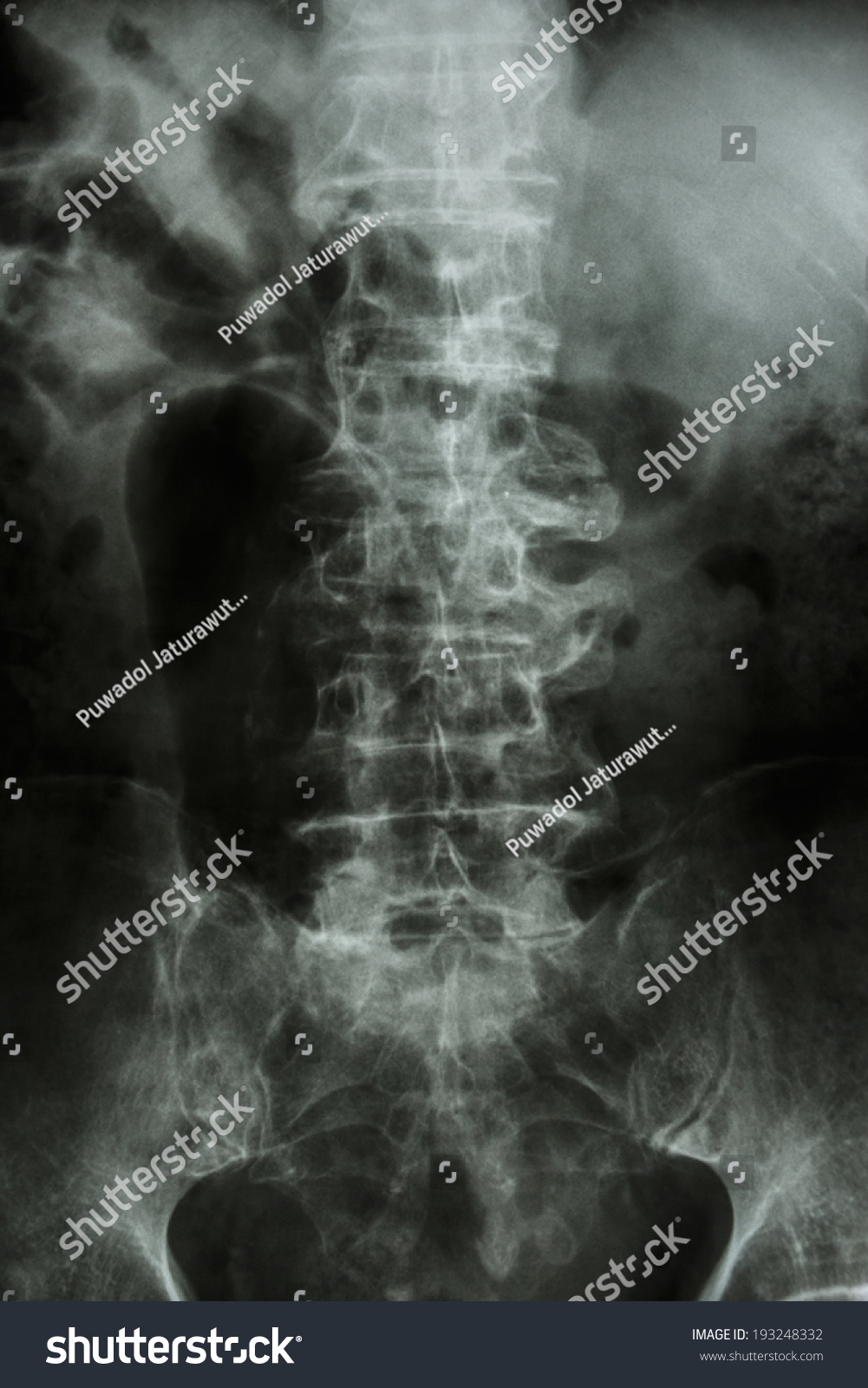 Spondylosis Film Xray Lumbar Spine Spur Stock Photo 193248332 ...