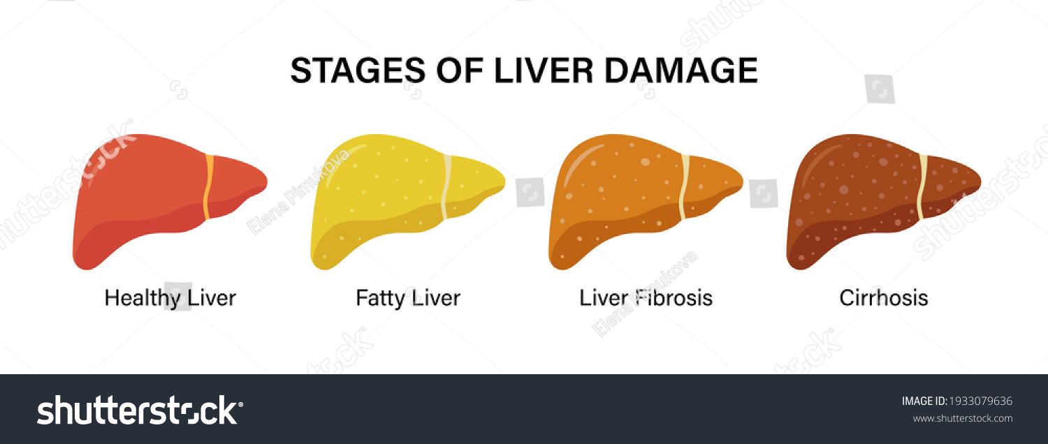 Stages Nonalcoholic Liver Damage Healthy Fatty Stock Vector (Royalty ...