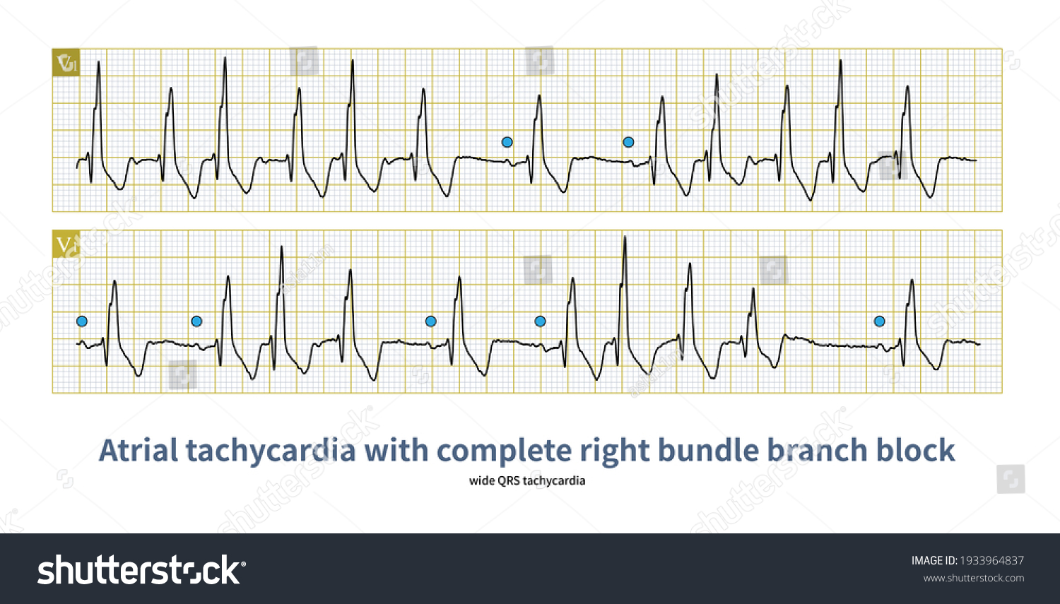 When Atrial Tachycardia Bundle Branch Block Stock Illustration ...