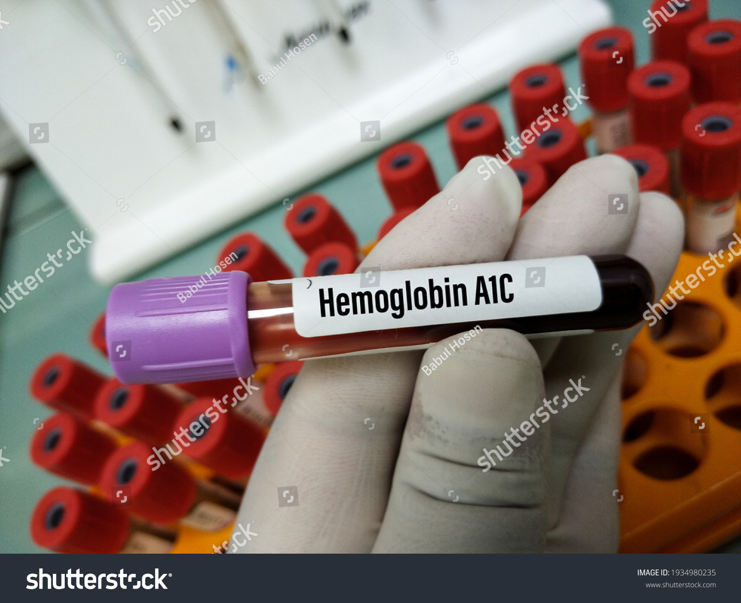 Blood Sample Hemoglobin A1c Hba1c Test Stock Photo 1934980235 ...