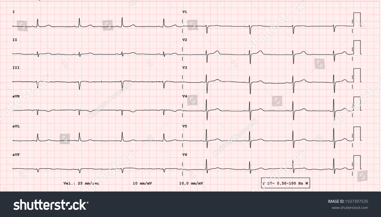 Ecg Example Bradycardia 12lead Rhythm Stock Illustration 1937397535 ...