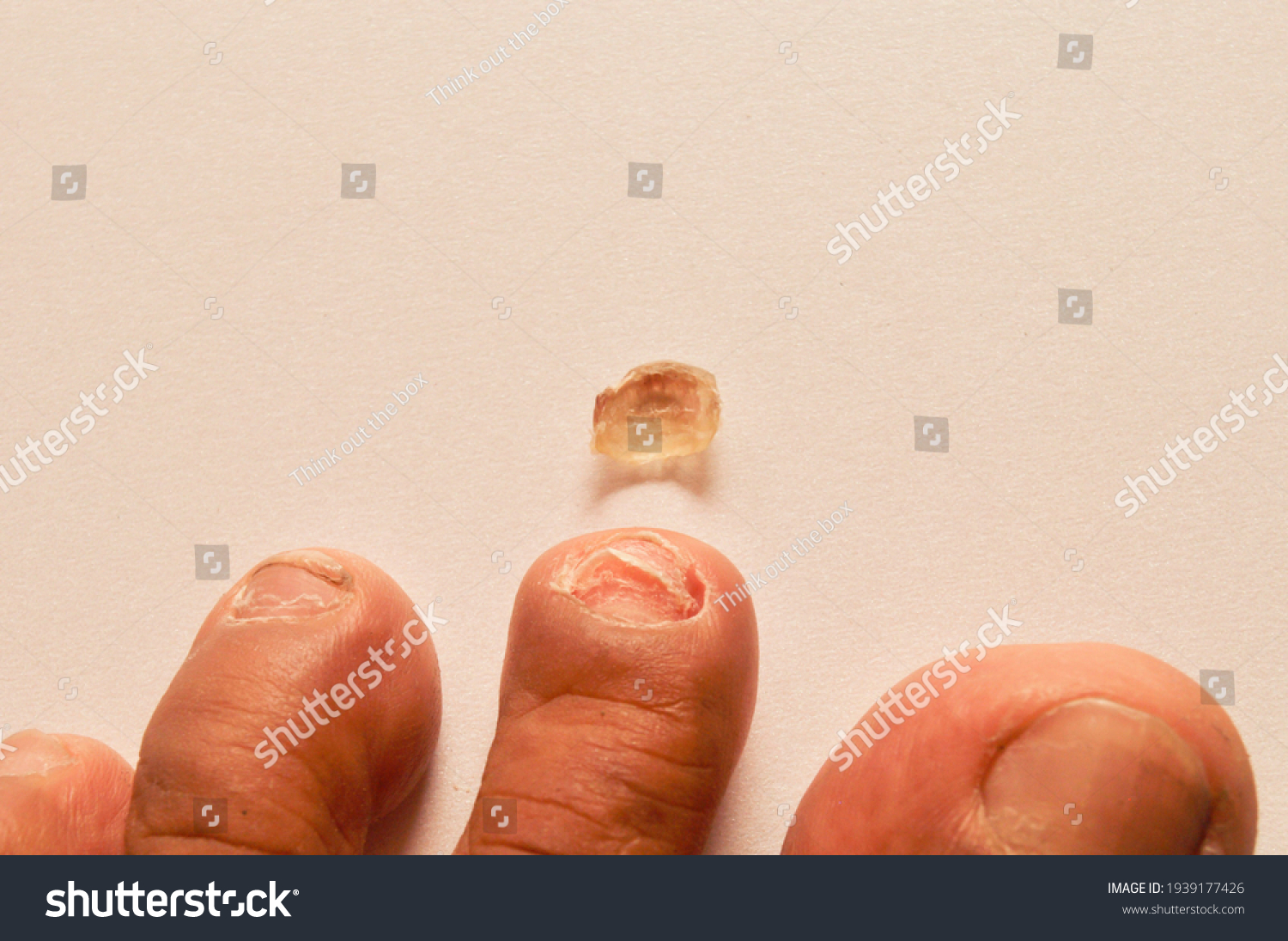 62 Nail Falling Off Images, Stock Photos & Vectors Shutterstock