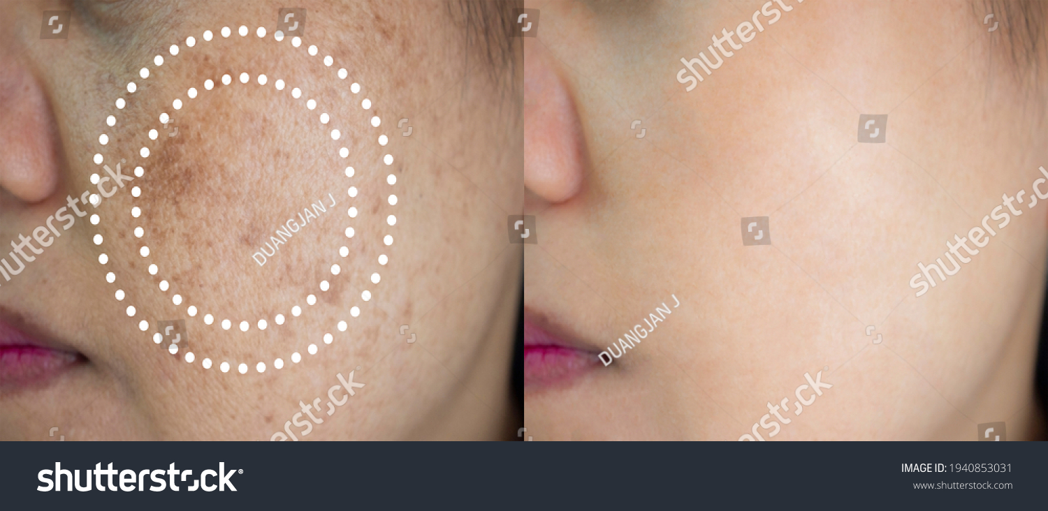 Image Before After Spot Melasma Pigmentation Stock Photo