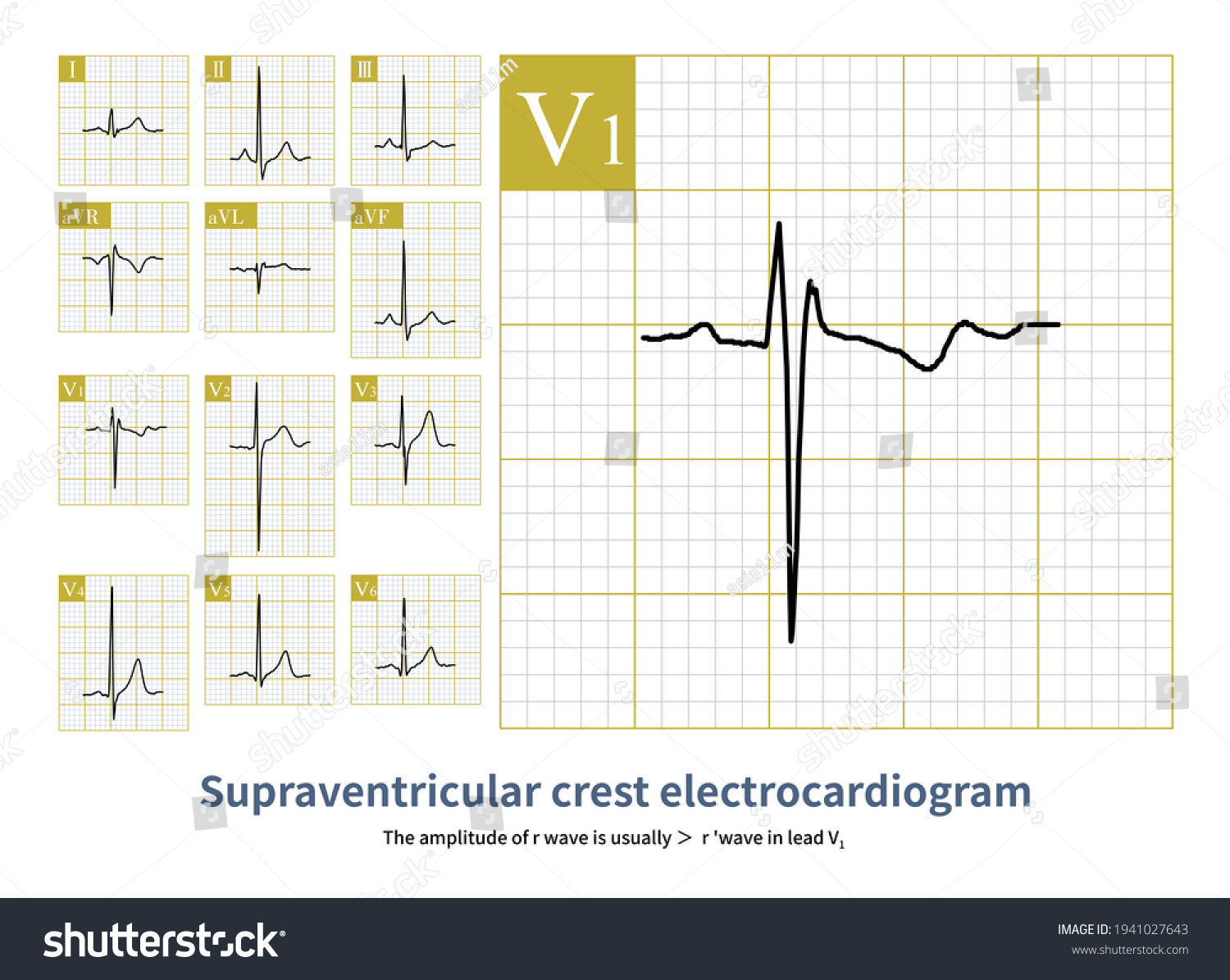 Supraventricular Ridge Ecg Similar Incomplete Right Stock Illustration ...