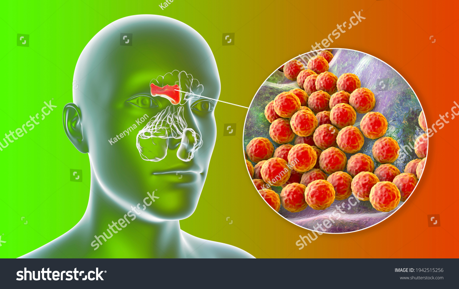 Sinusitis Inflammation Paranasal Cavities 3d Illustration Stock Illustration 1942515256