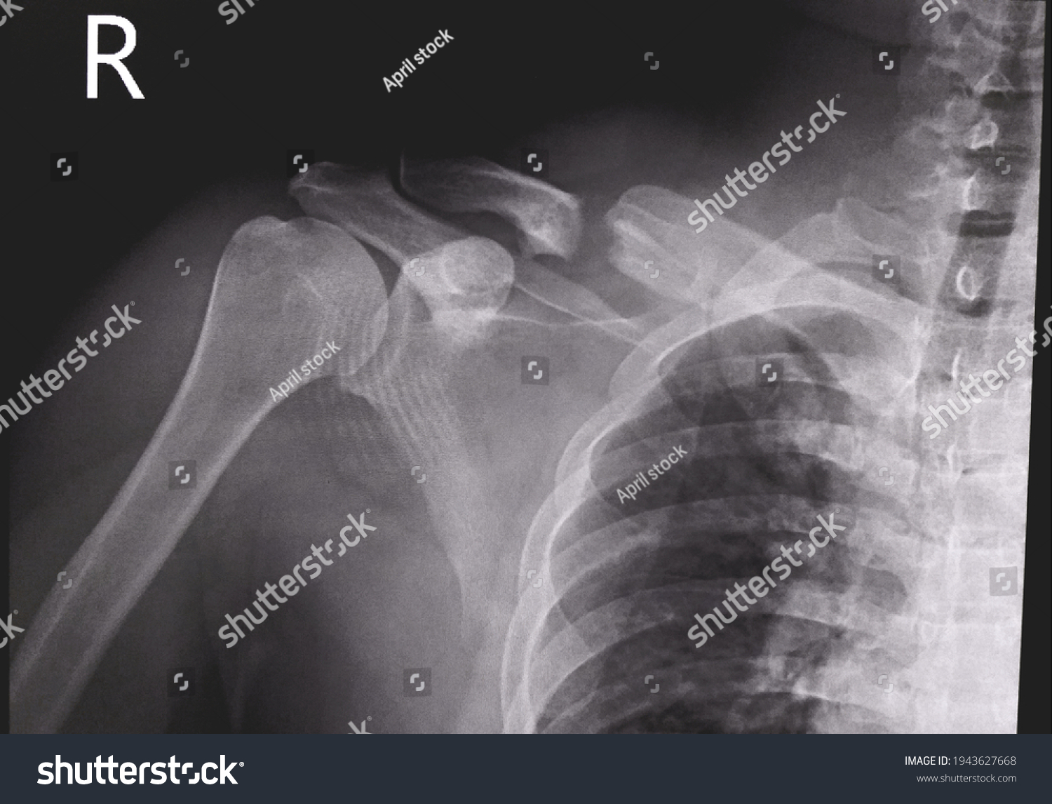 Shoulder Xray Case Accident Showing Fracture Stock Photo Shutterstock