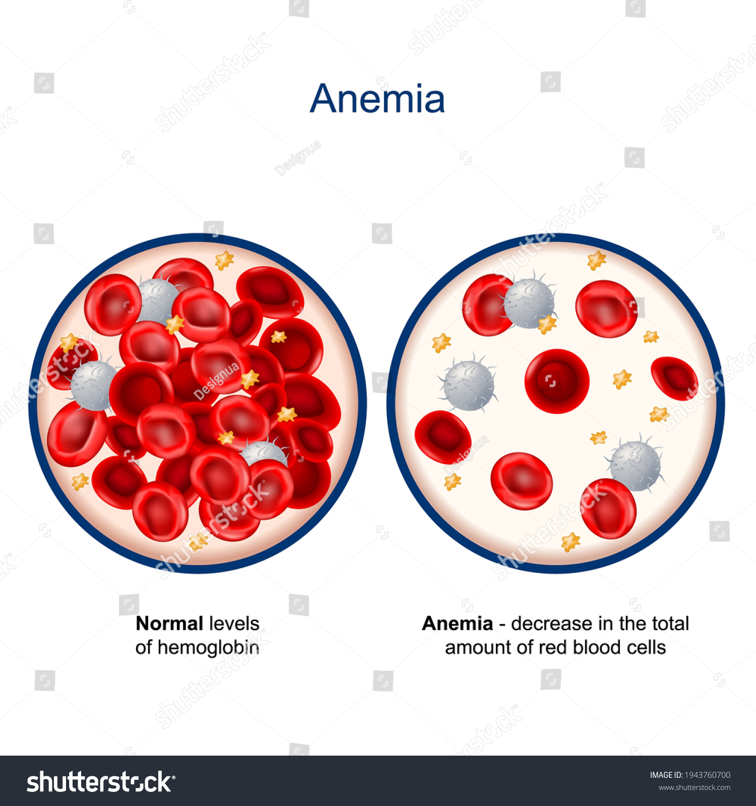 anemia-comparison-difference-between-normal-levels-stock-vector-royalty-free-1943760700