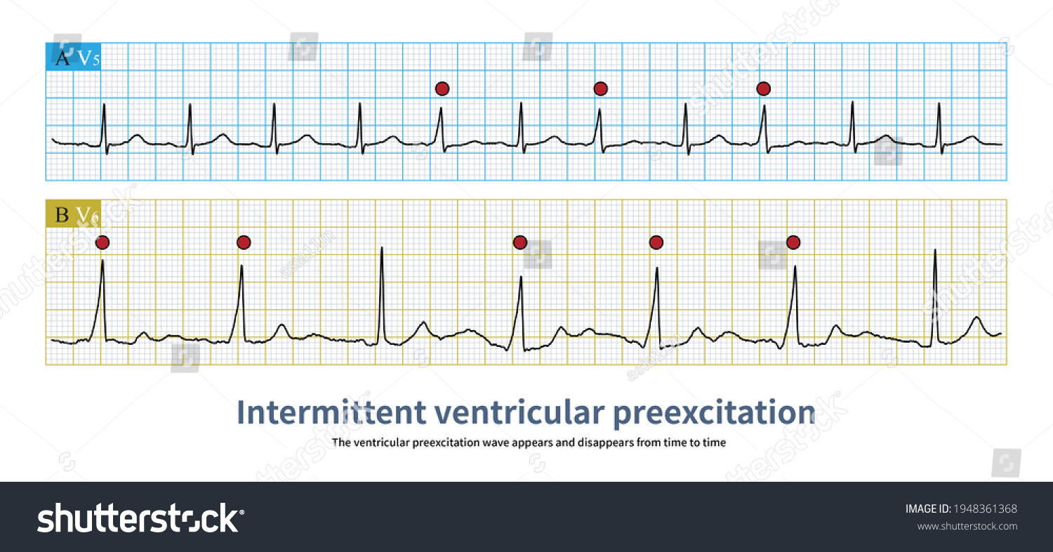 Conduction Function Atrioventricular Accessory Pathway Unstable Stock ...