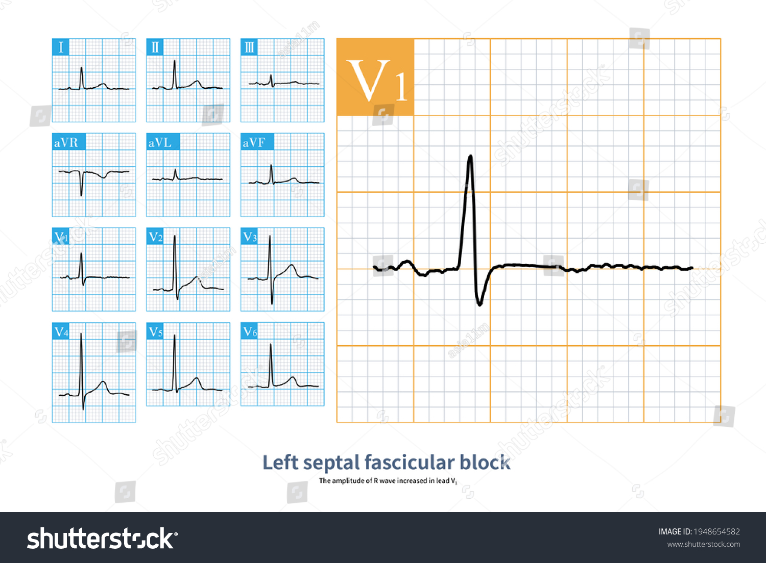 59 Year Old Man Diagnosed Coronary Stock Illustration 1948654582 ...