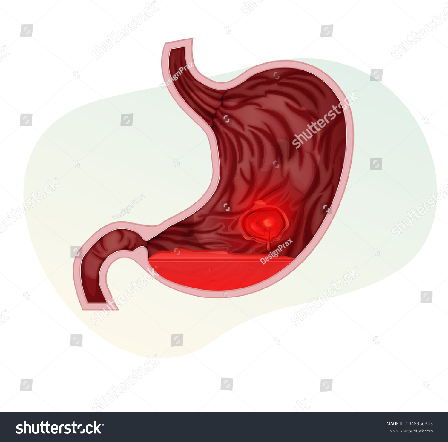 Peptic Ulcer Stomach Ache Illustration Eps Stock Vector (royalty Free 