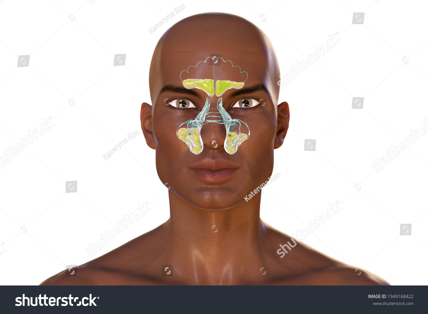 Sinusitis Inflammation Paranasal Cavities 3d Illustration Stock Illustration 1949168422