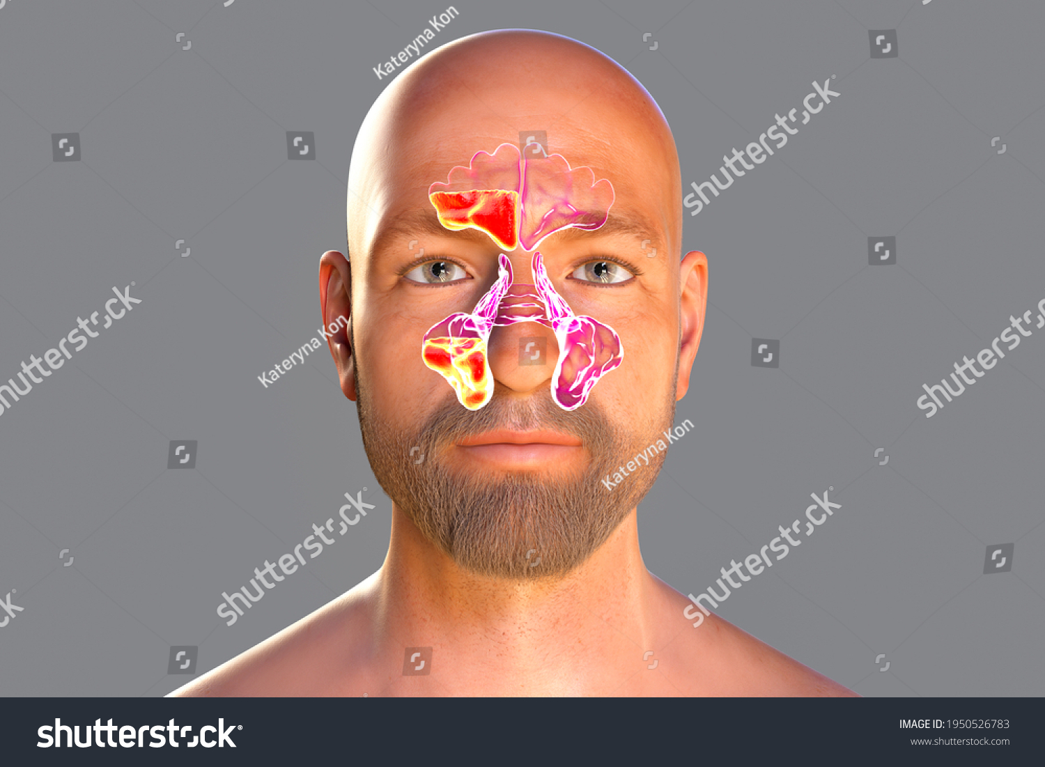 Sinusitis Inflammation Paranasal Cavities 3d Illustration Stock Illustration 1950526783