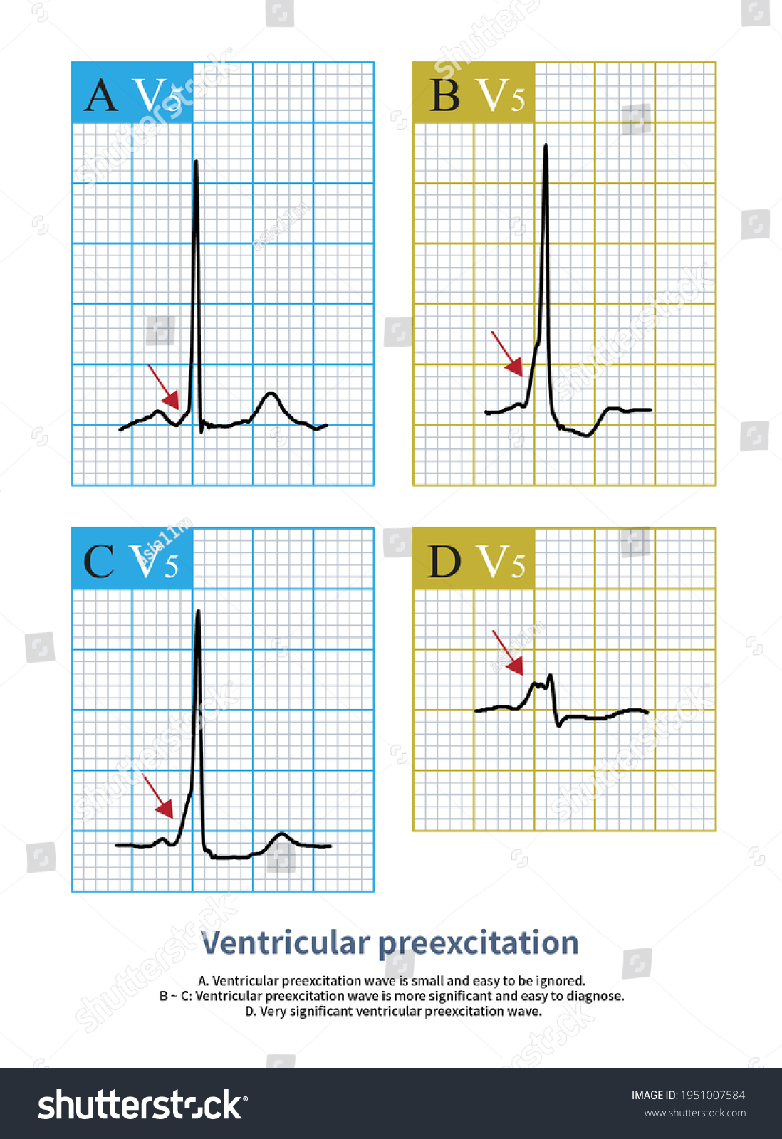 Some Ventricular Preexcitation Waves Small Easy Stock Illustration ...