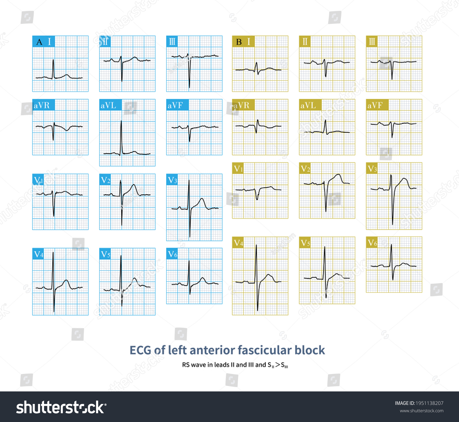 During Left Anterior Fascicular Block Main Stock Illustration ...