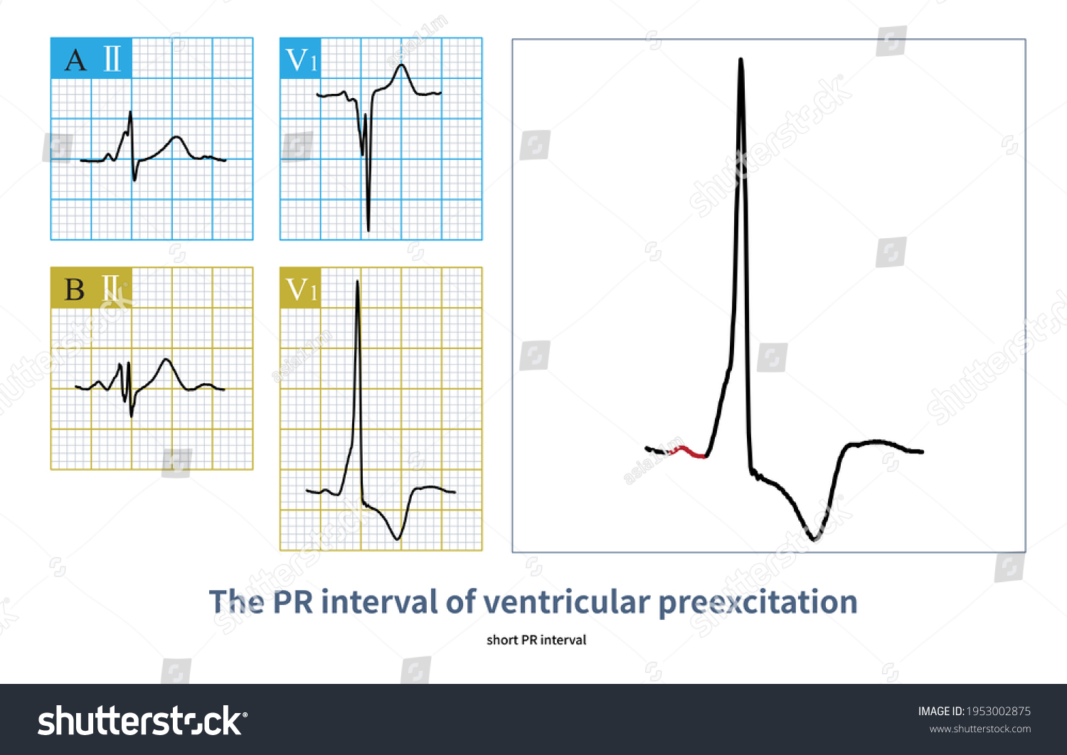 Individuals Atrioventricular Accessory Pathway Partial Ventricular ...