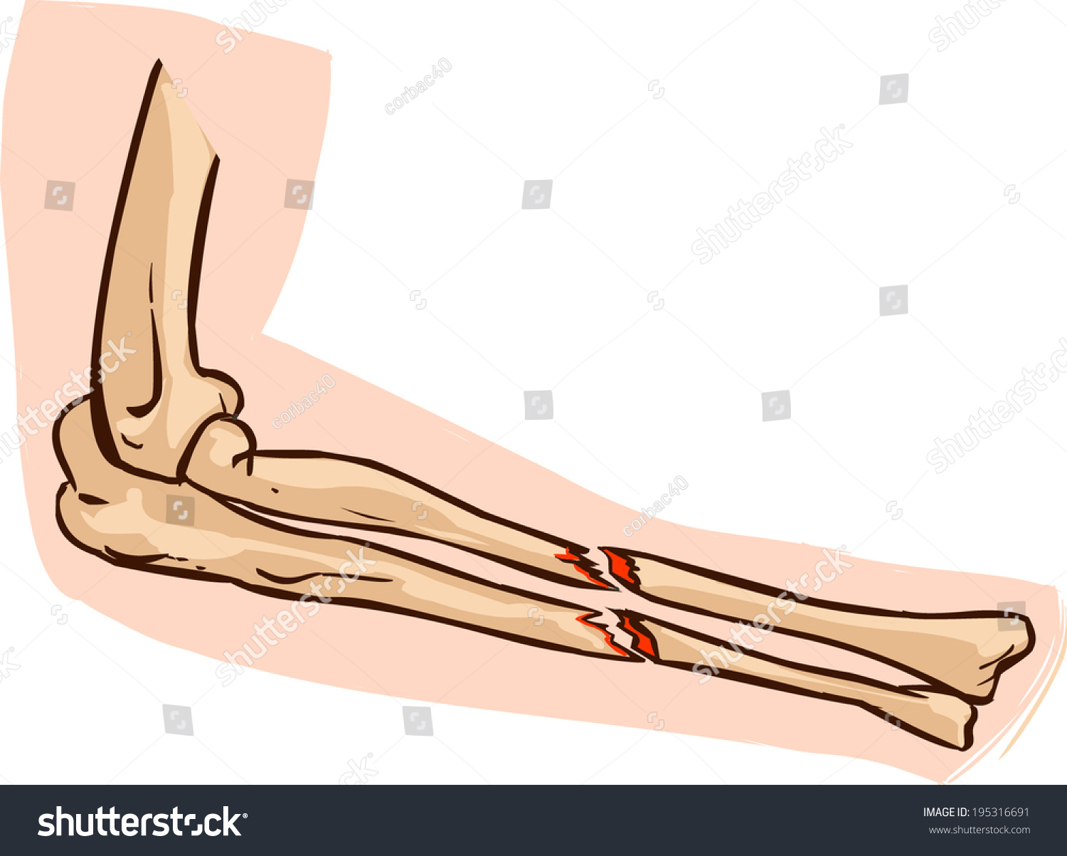 Картина перелома костей руки