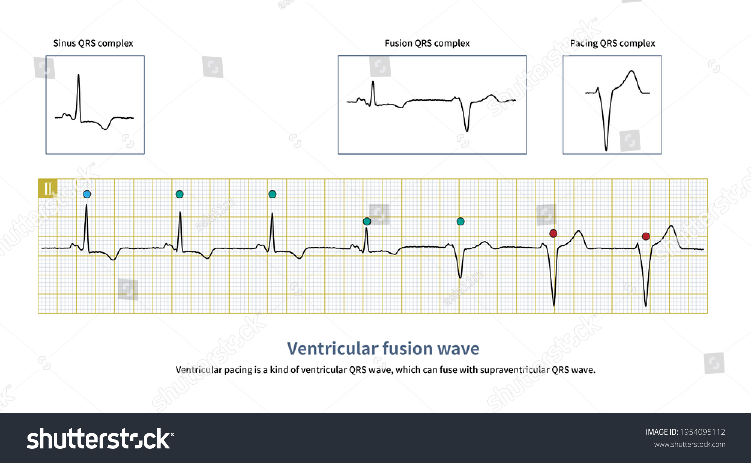 Ventricular Pacing Kind Ventricular Qrs Wave Stock Illustration ...