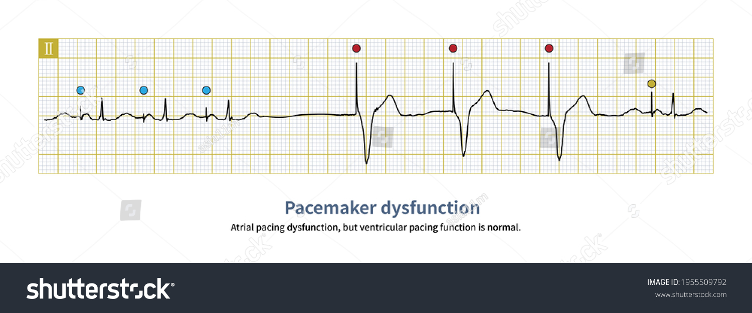 When Dual Chamber Pacemaker Fails Complex Stock Illustration 1955509792 ...