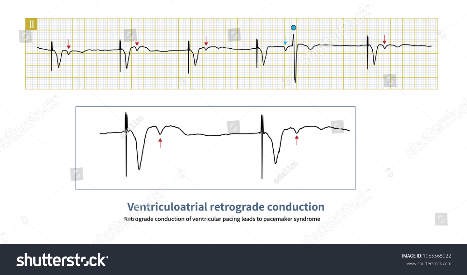 Electrical Signal Produced By Ventricular Pacing Stock Illustration ...