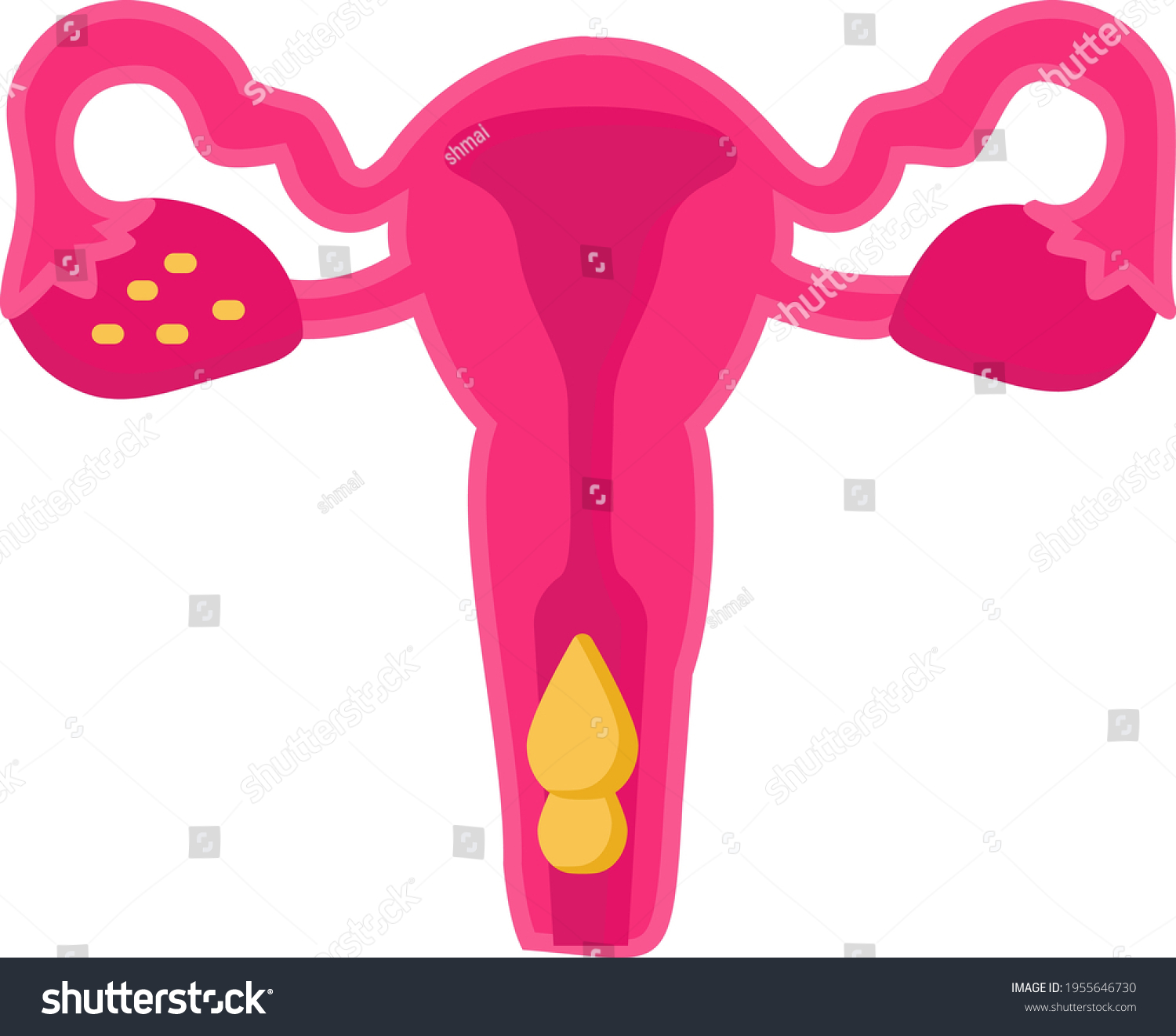 Abnormal Uterine Bleeding Concept Extremely Heavy Stock Vector (Royalty ...