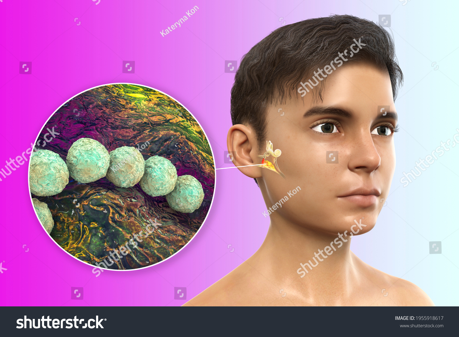 streptococcus-pyogenes-bacterium-cause-otitis-media-stock-illustration