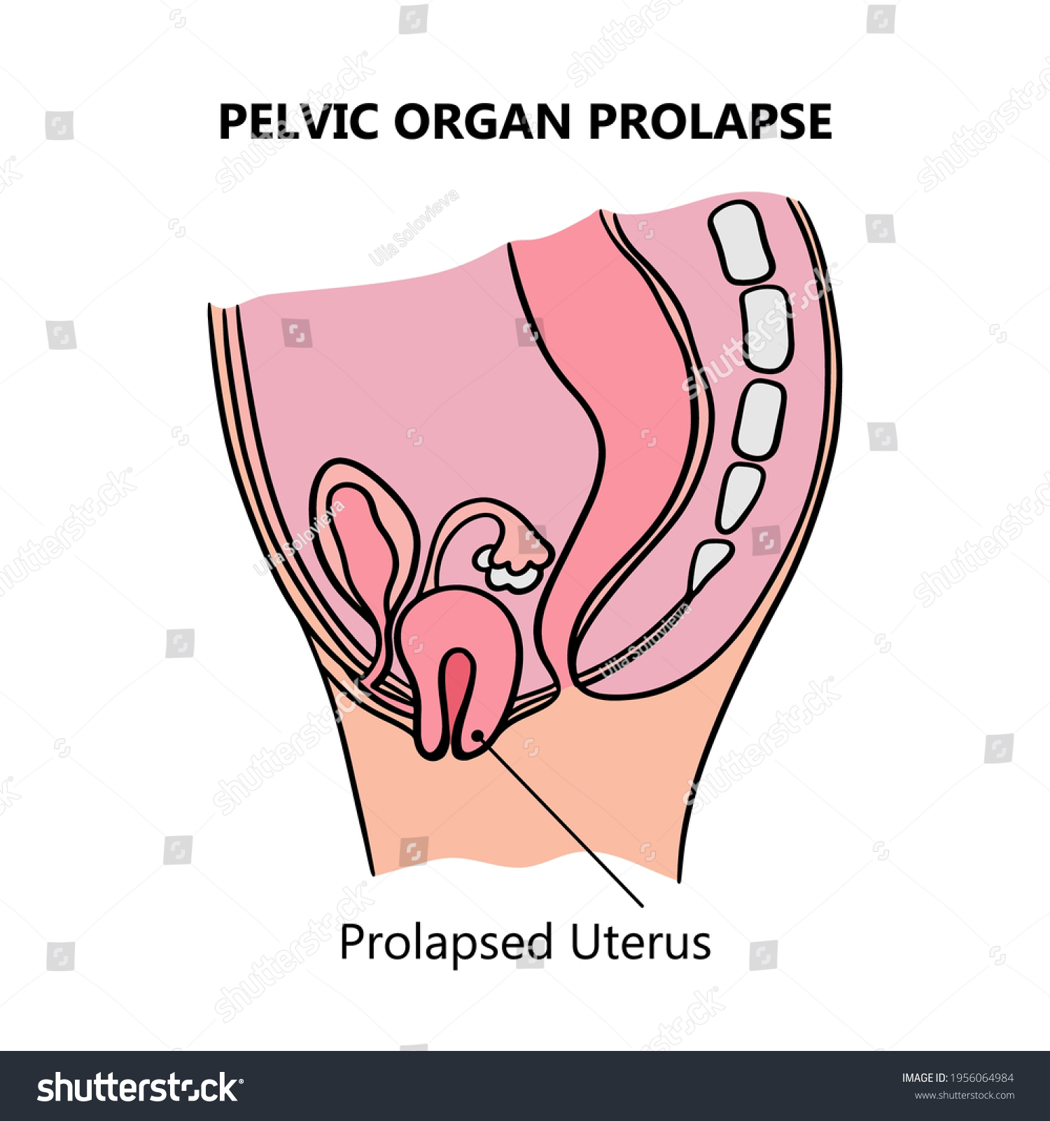 Prolapsed Uterus Women General Diagram Explanatory Stock Vector