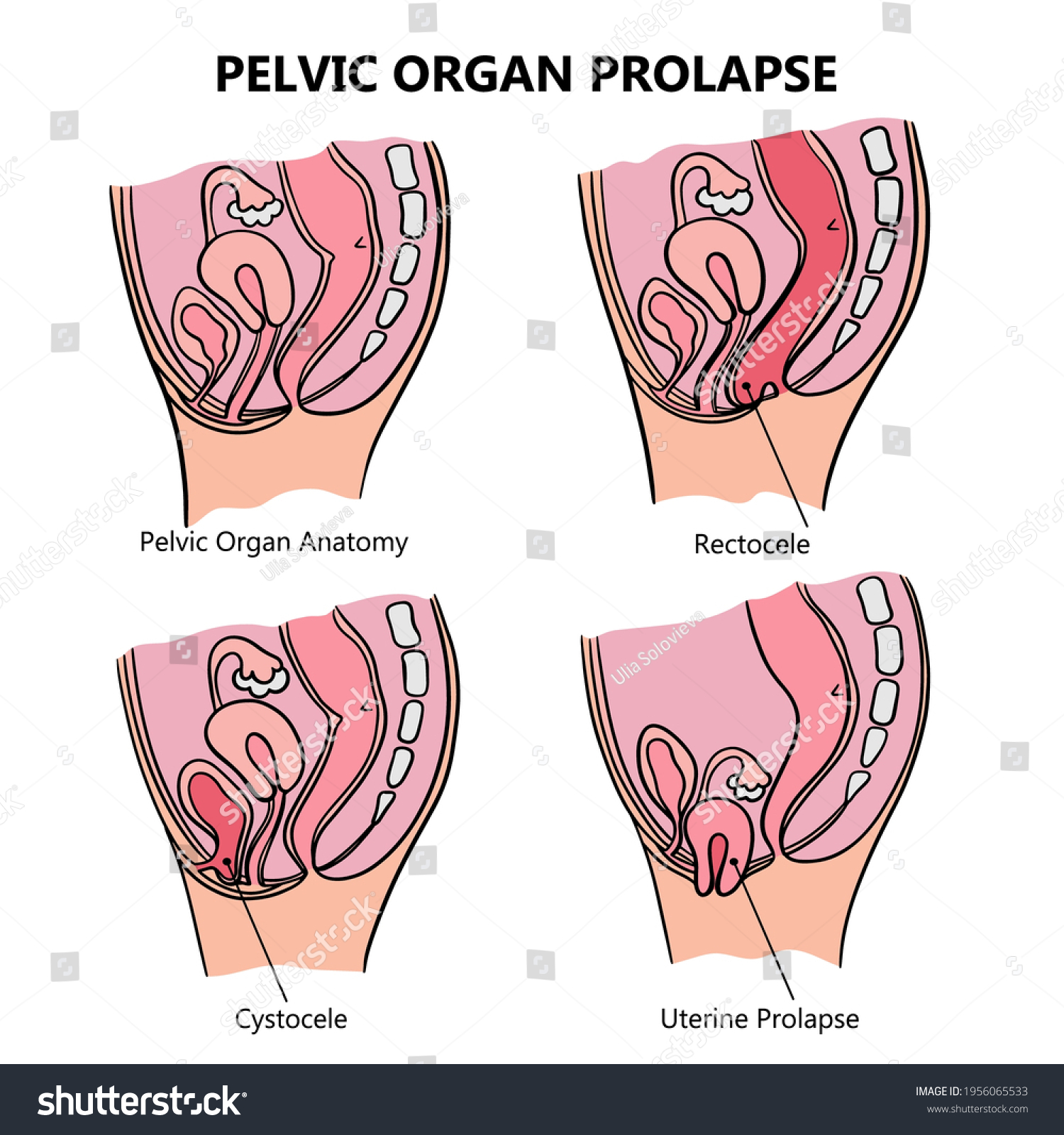 Prolapse Anime