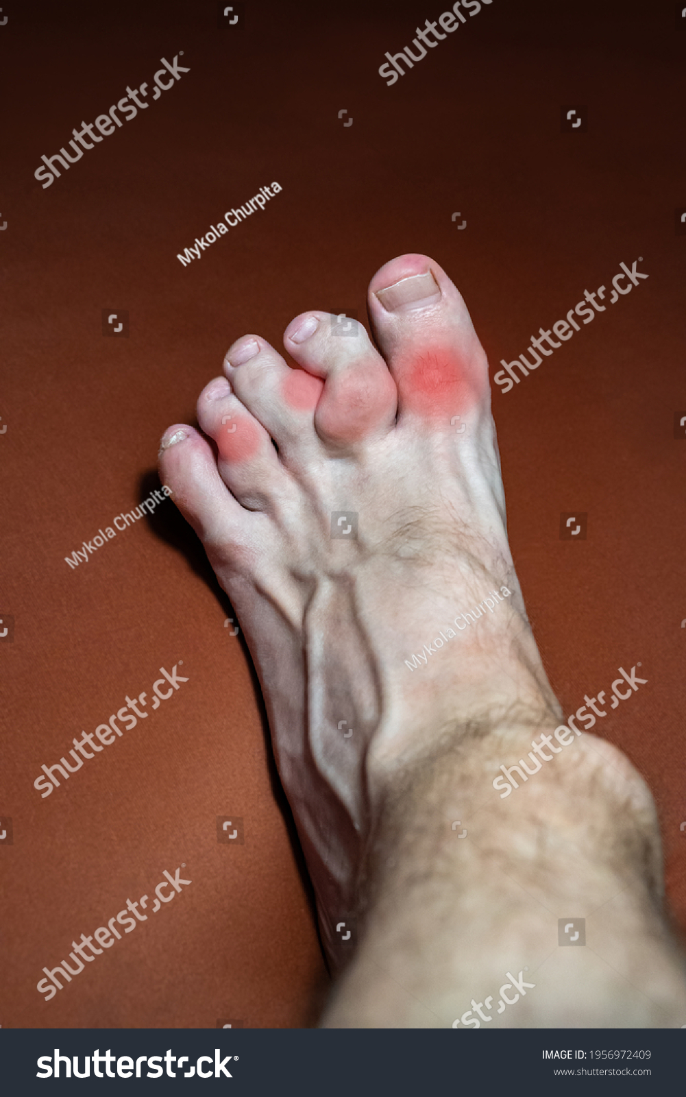 Leg Gouty Toes Marked Red Toes Stock Photo 1956972409 Shutterstock