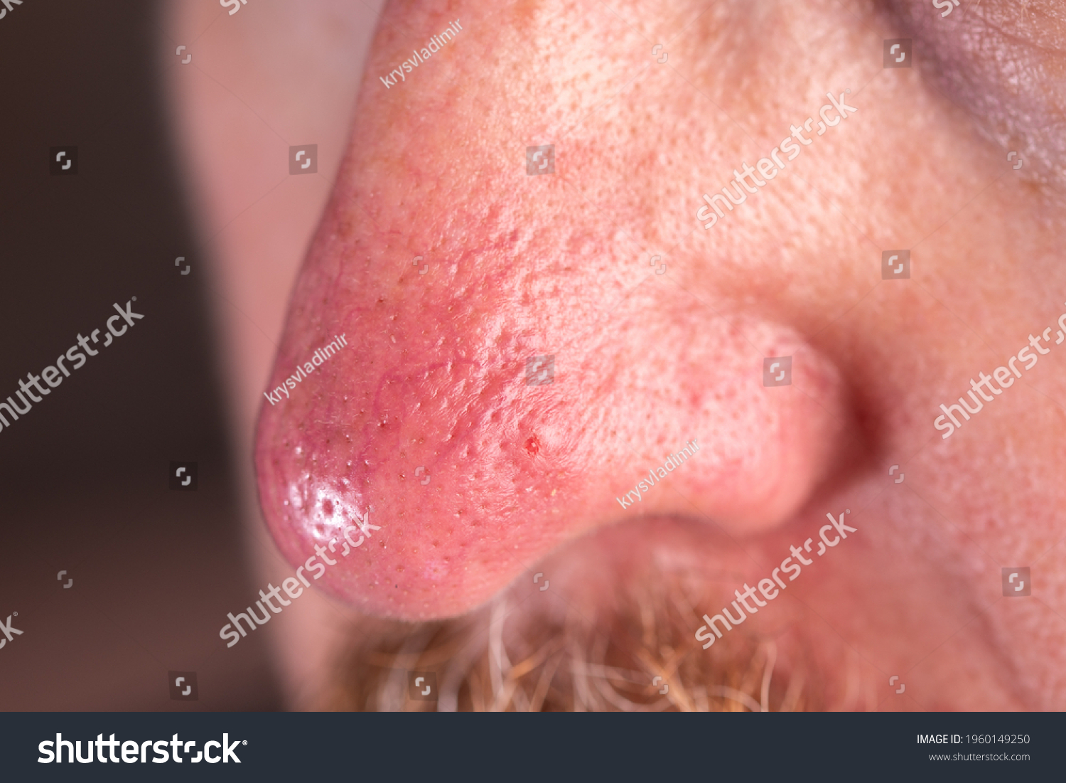 surface-skin-on-nose-rosacea-eczema-stock-photo-1960149250-shutterstock