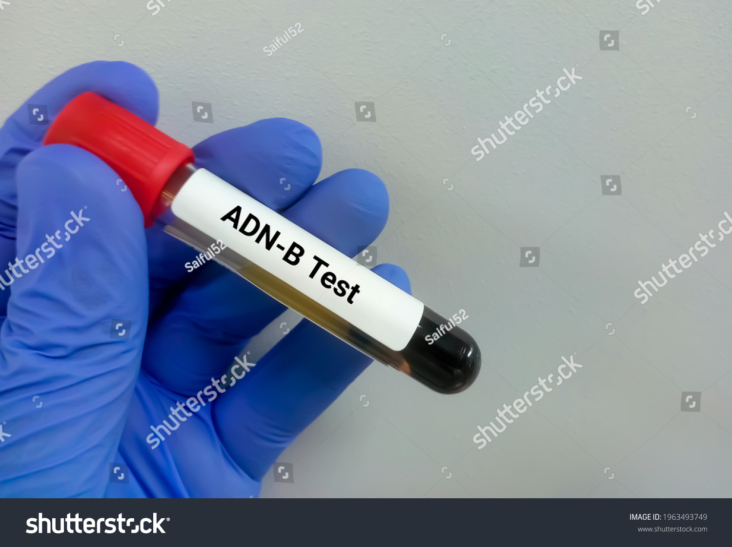 1 Antideoxyribonuclease B Titer Images, Stock Photos & Vectors ...