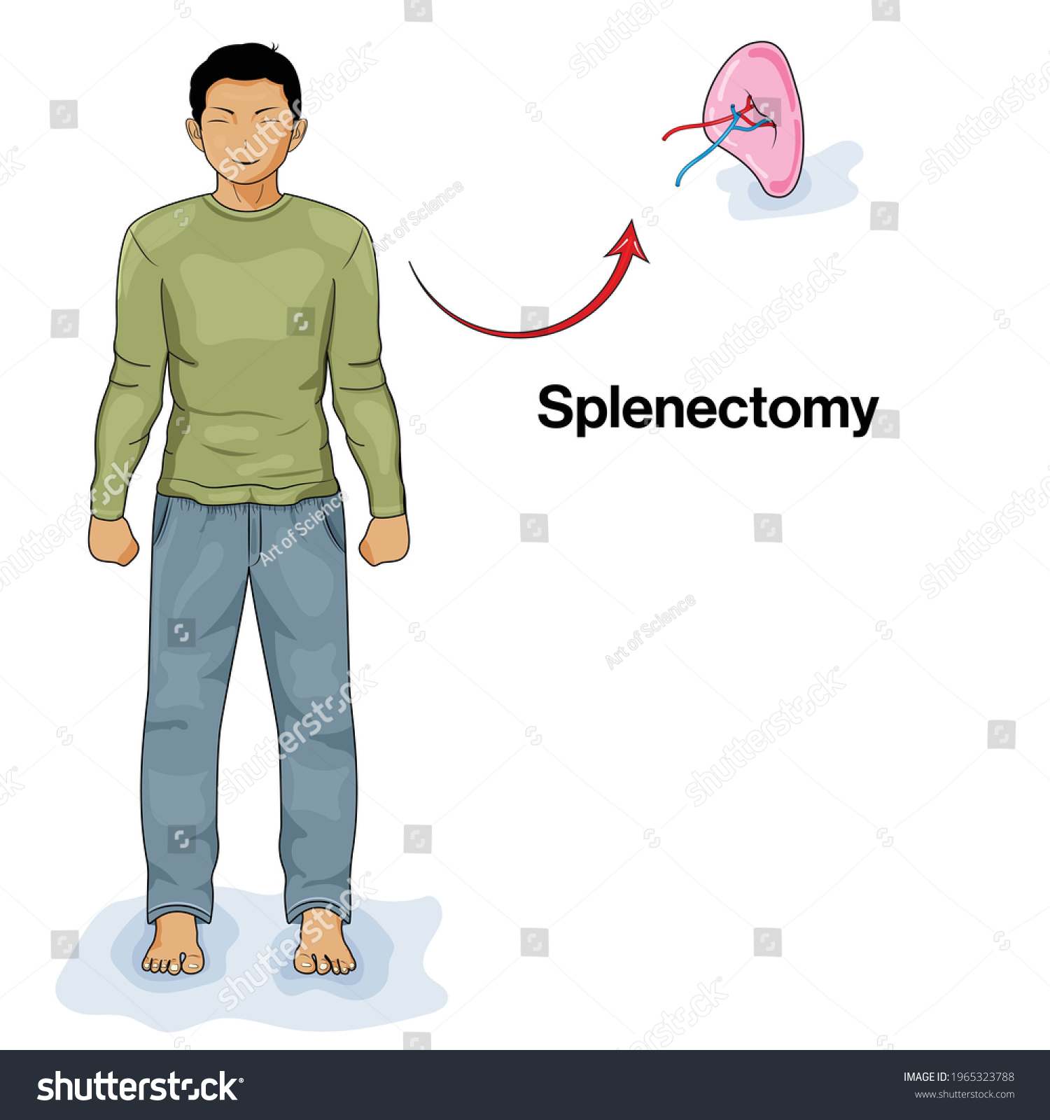 Illustration Splenectomy Humans Removal Spleen Using Vector De Stock Libre De Regalías 9370