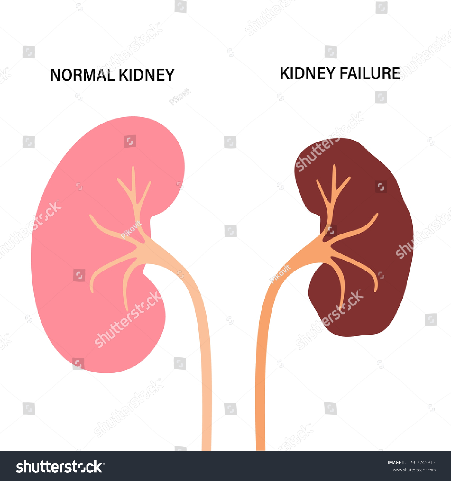 Failure Kidney Normal Kidney Icons Anatomical Stock Vector (Royalty ...