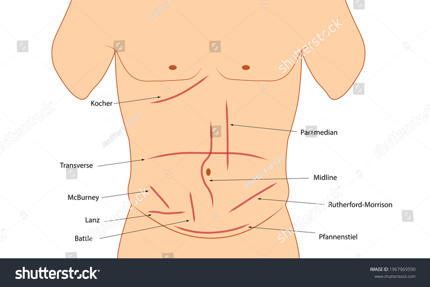 Abdominal Incision Different Types Abdominal Incision 스톡 일러스트 1967969590 Shutterstock 