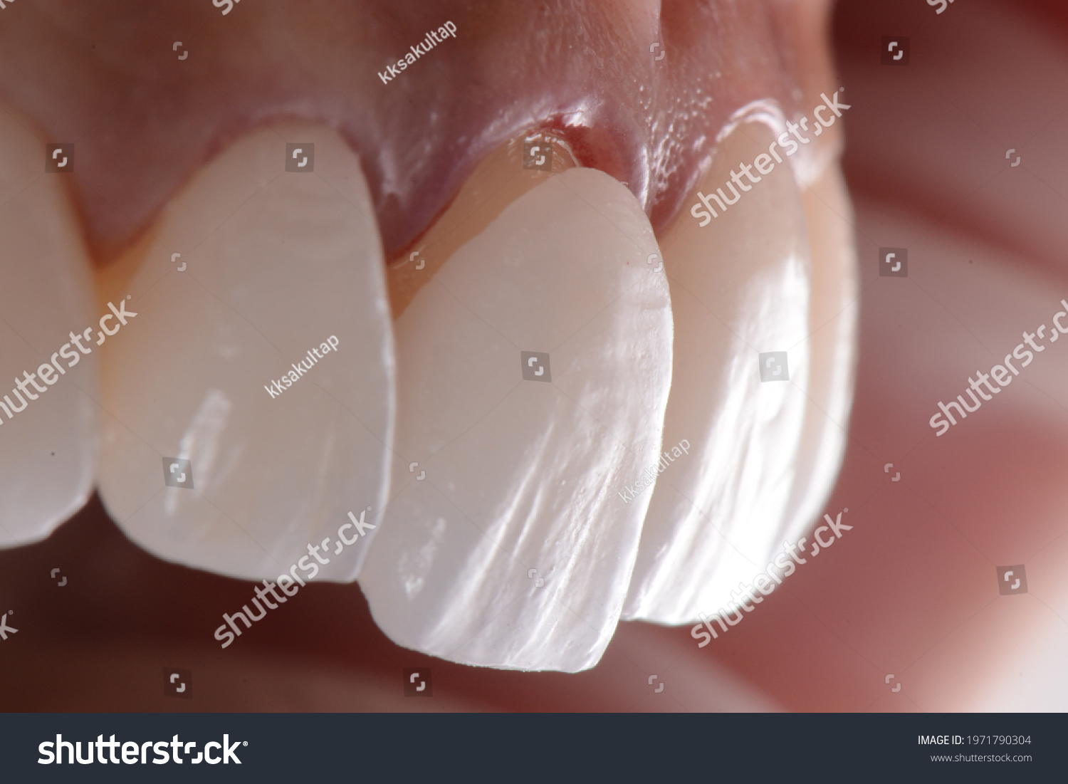 Placing Porcelain Laminated Veneers Smile Makeover Stock Photo ...