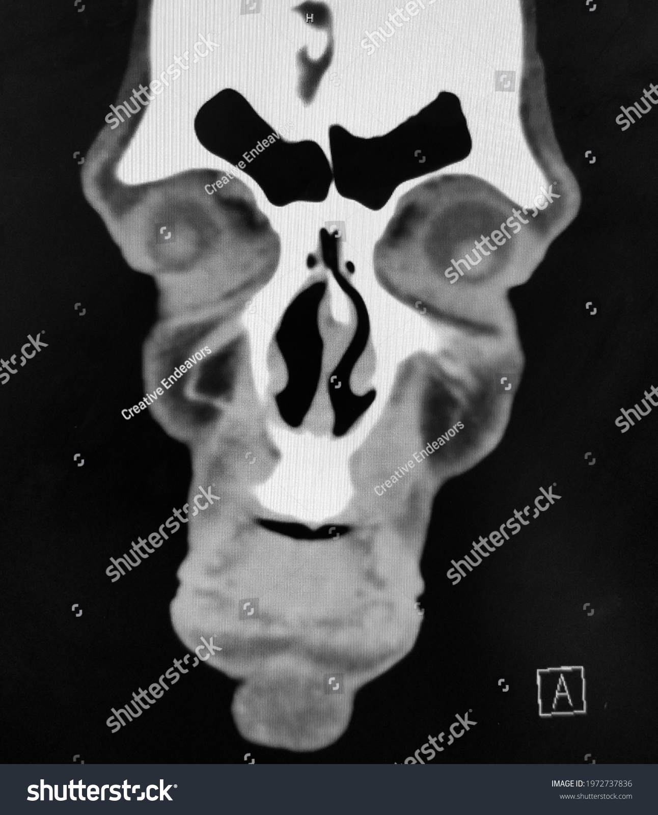 Coronal Ct Scan Sinuses Face Stock Photo 1972737836 | Shutterstock