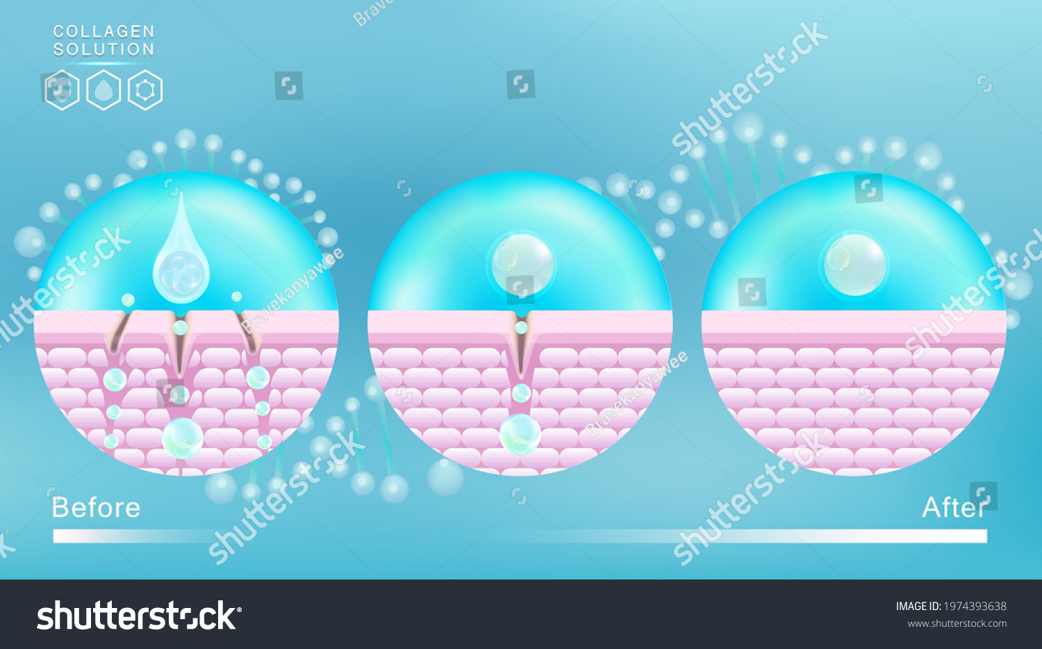 Hyaluronic Acid Before After Skin Solutions Stock Vector (Royalty Free ...