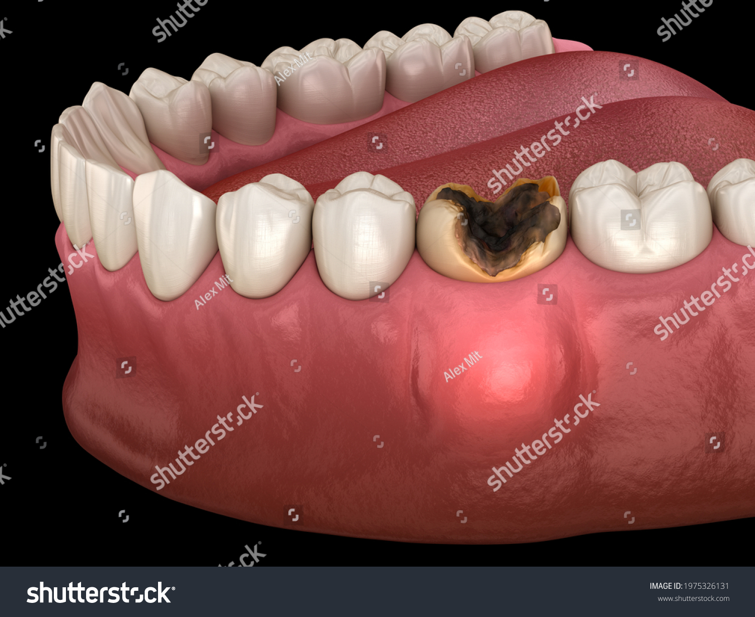 periostitis-tooth-lump-on-gum-above-stock-illustration-1975326131