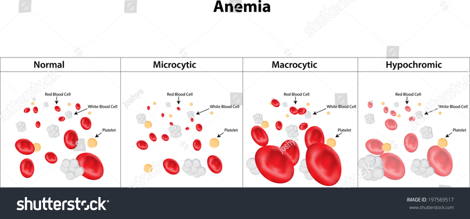 Mch анемия. Анемия рисунок. Анемия эритроциты. Эритроциты в крови анемия. Микроцитик анемия.