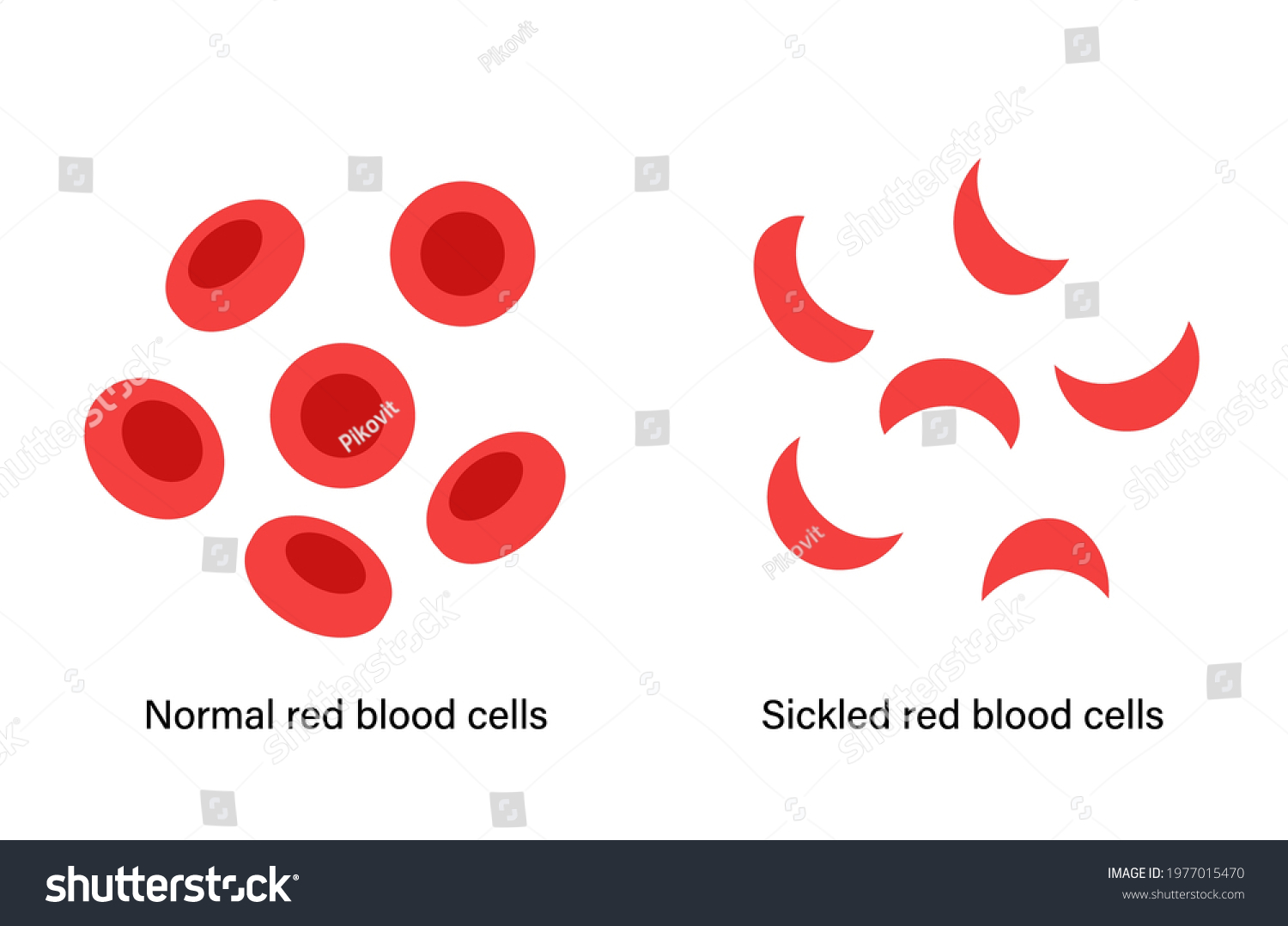 Comparison Normal Blood Sickle Cells Anemia Stock Vector (Royalty Free ...