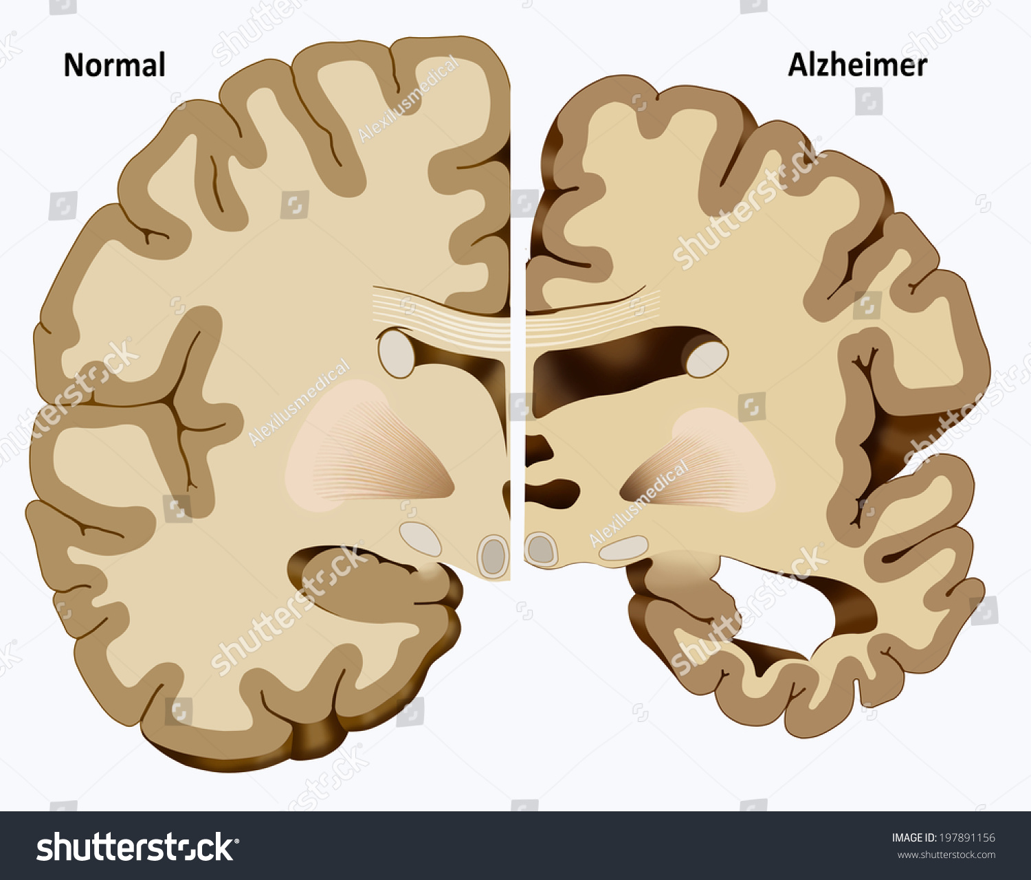 Brain 172. Расширение желудочков головного мозга. Увеличенные желудочки головного мозга у больных шизофренией.