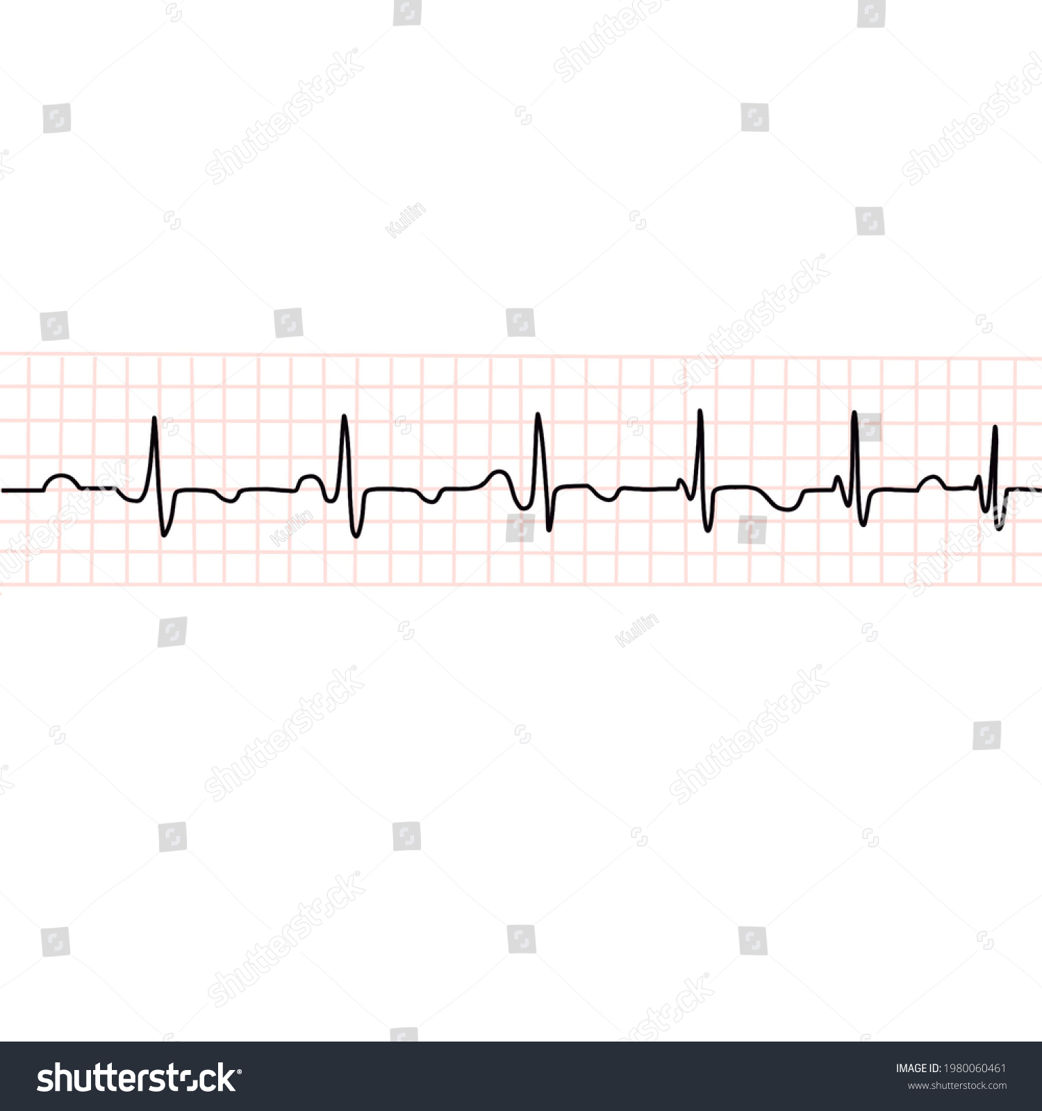 Illustration Cardiac Rhythm Showing Arrhythmia Electrocardiography ...