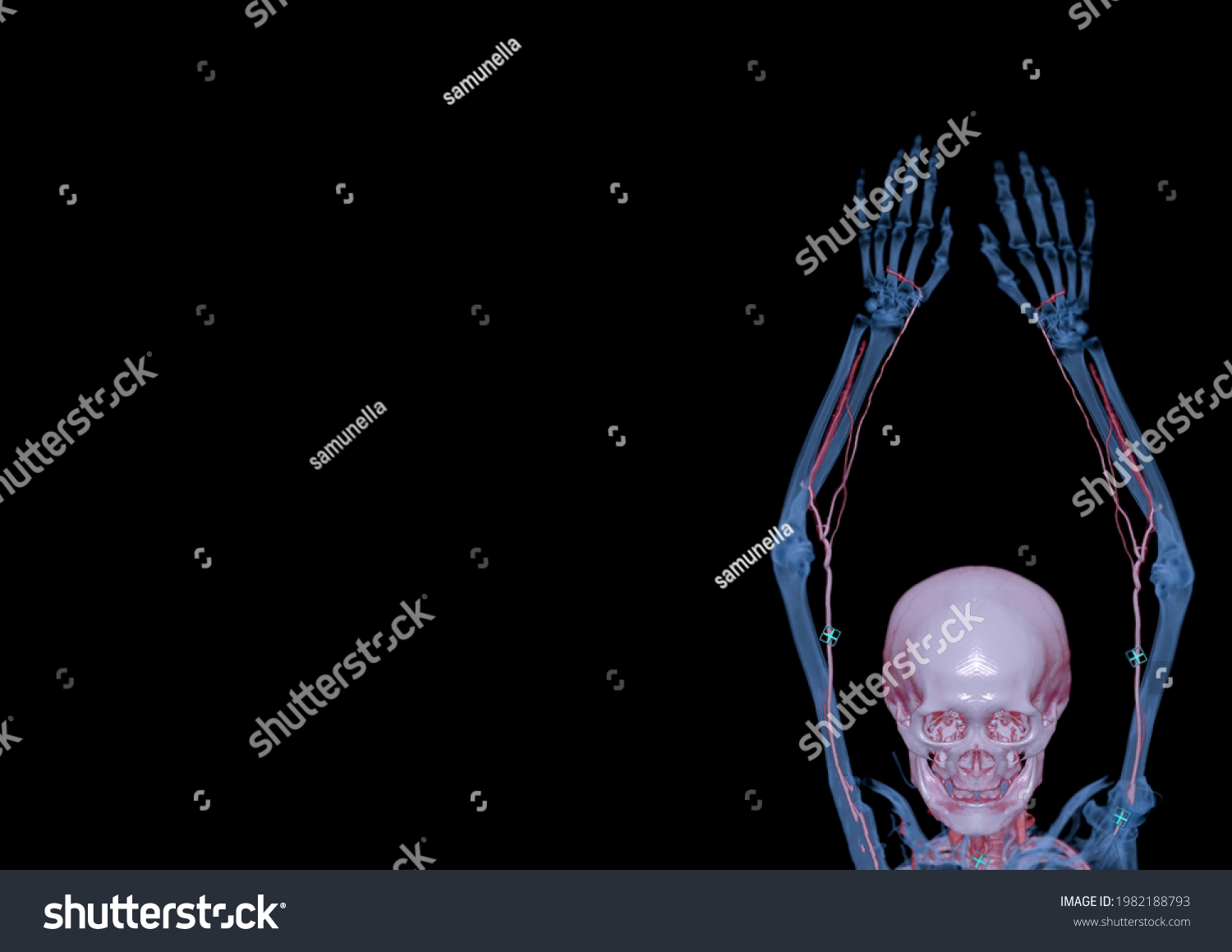 Cta Brachial Artery Ct Scan Upper Stock Illustration 1982188793