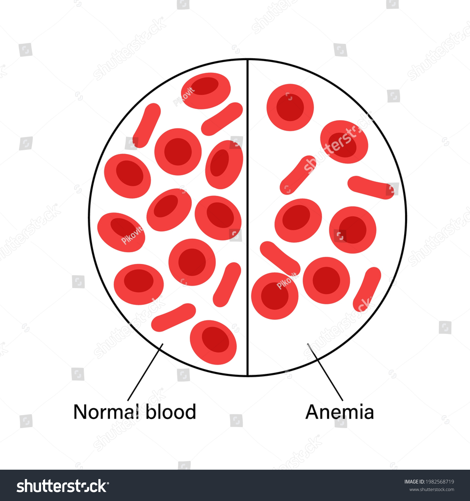 Normal Blood Specimen Anemia Disease Human Stock Vector (Royalty Free ...