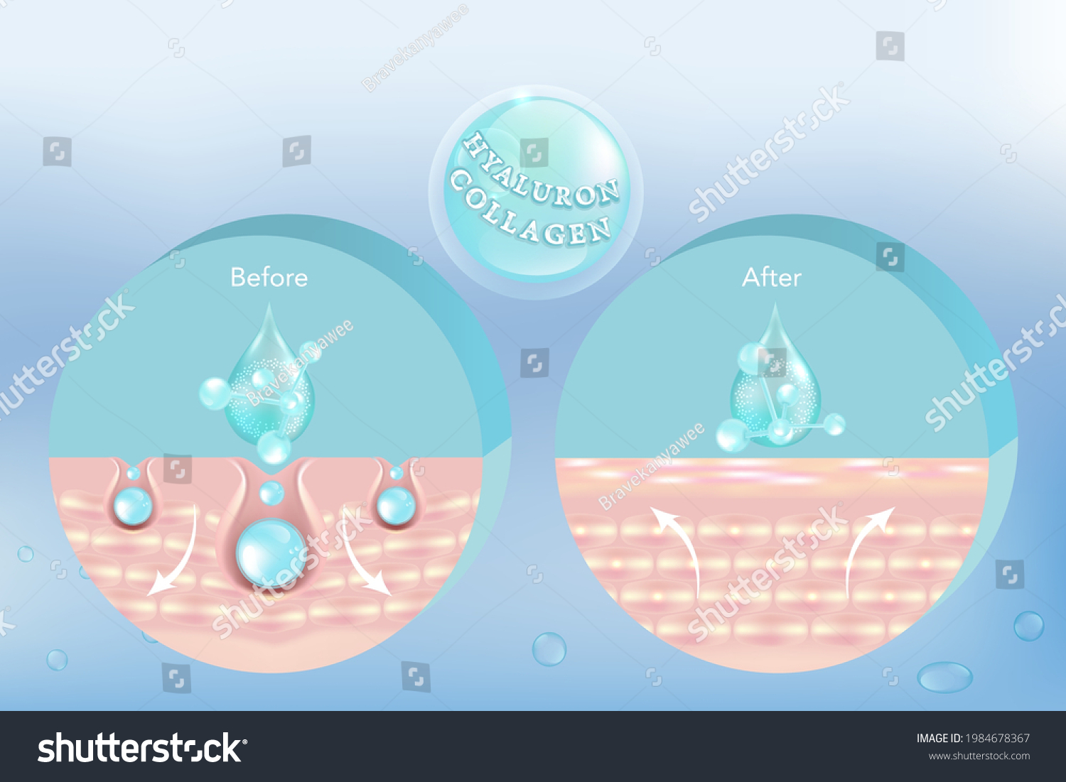 Hyaluronic Acid Before After Skin Solutions Stock Vector (Royalty Free ...