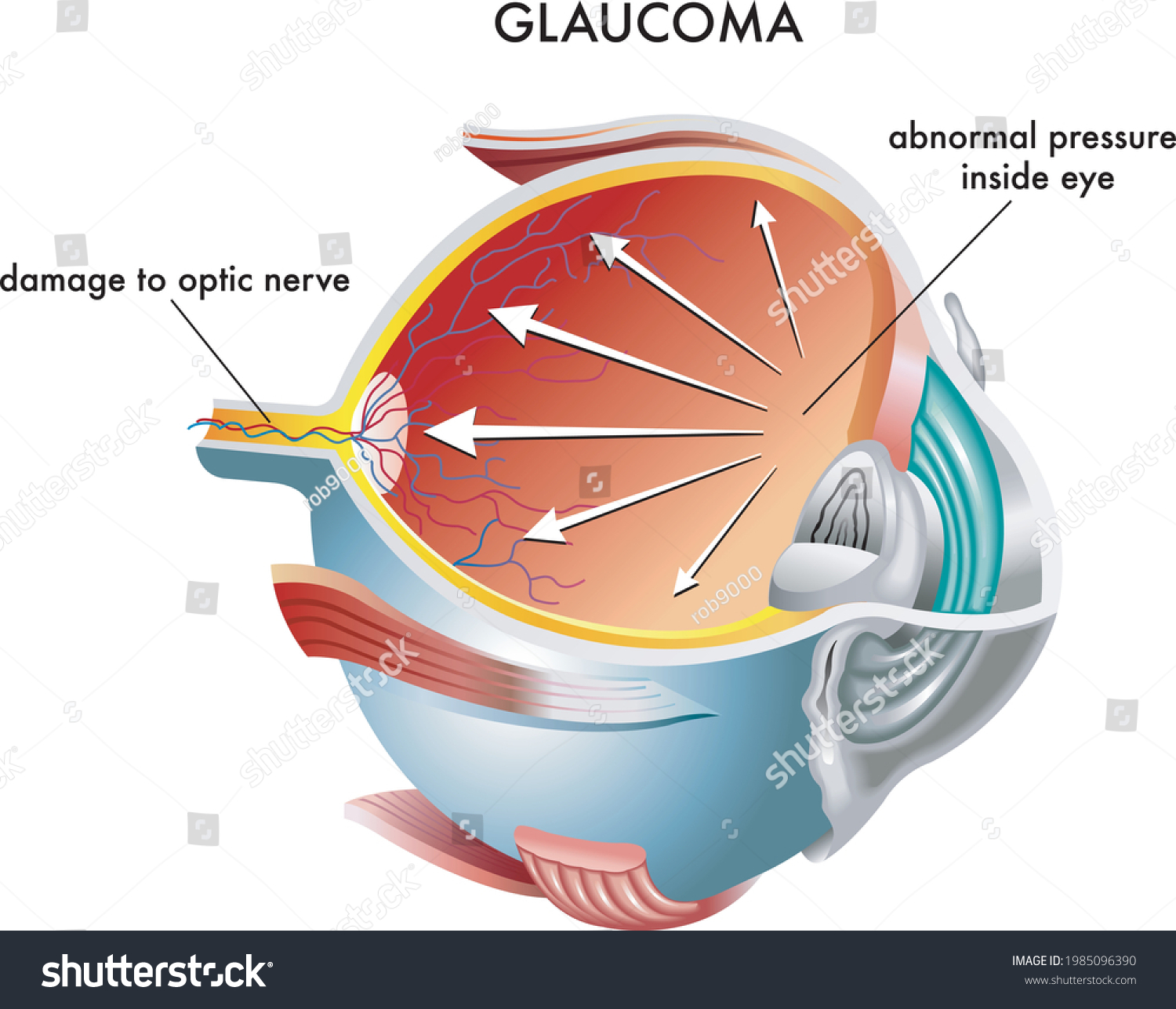 Medical Illustration Causes Glaucoma Stock Vector Royalty Free 1985096390 Shutterstock 5658