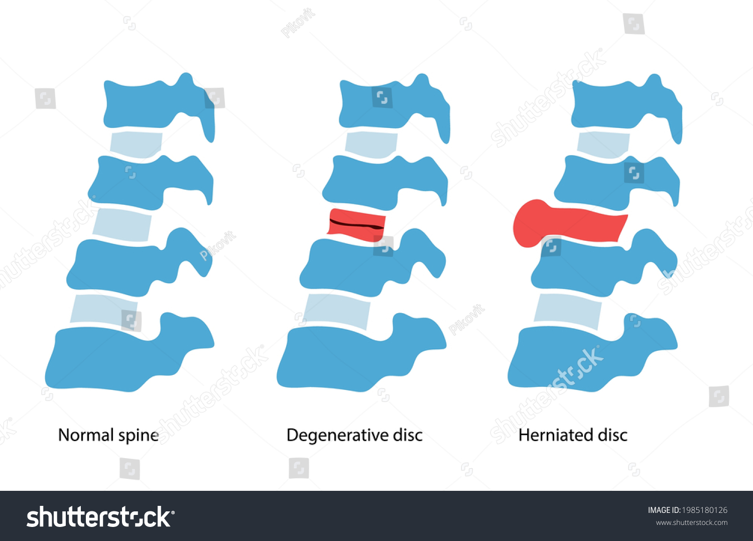 Spine Disease Normal Backbone Degenerative Disc Stock Vector (Royalty ...