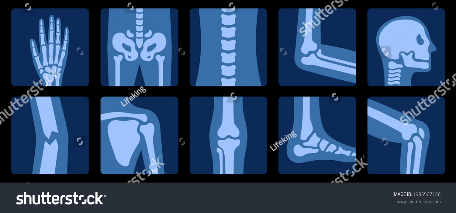 Xray Bones Xrays Examination Human Joint Stock Vector (Royalty Free ...