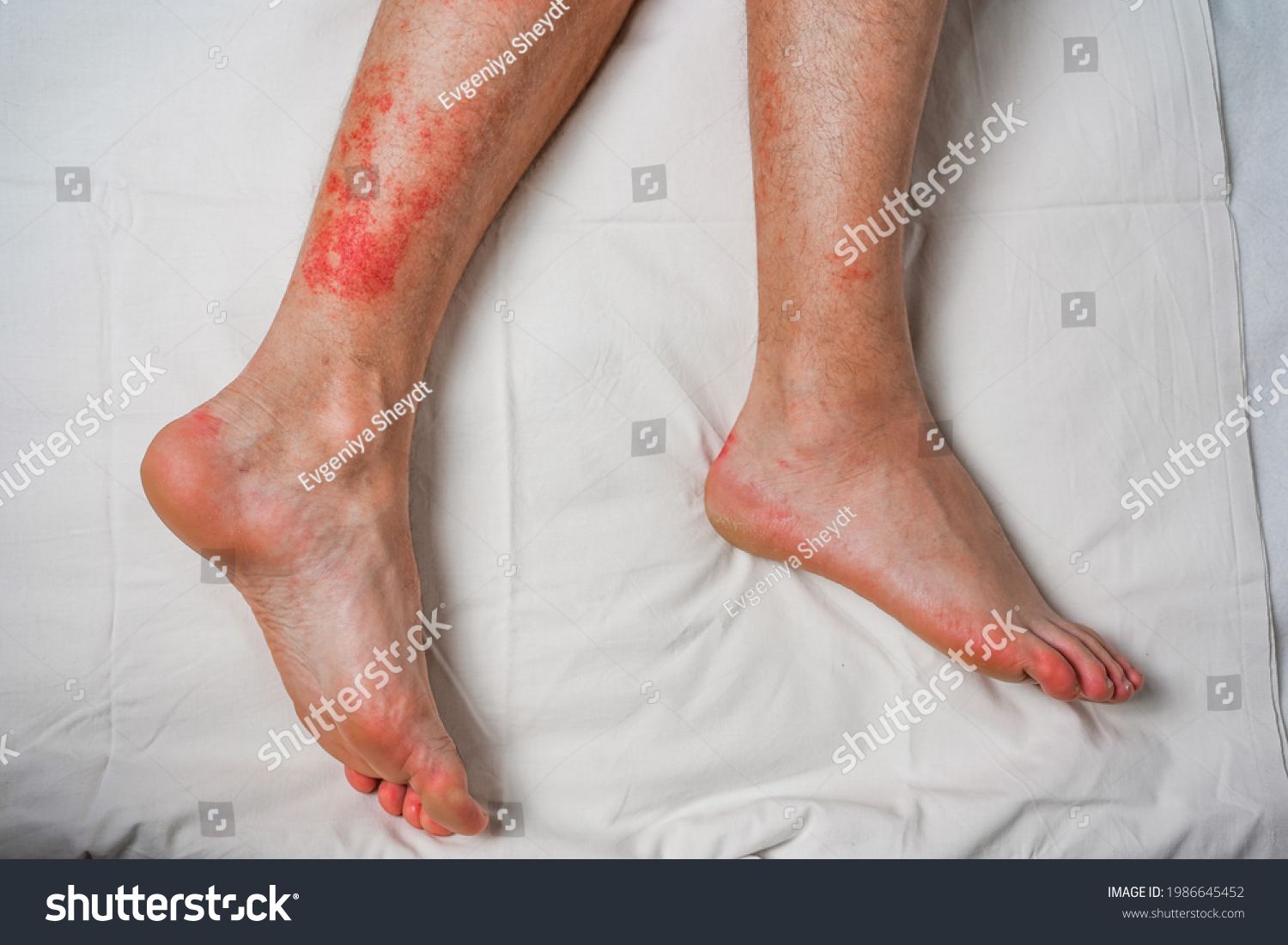 Male Leg Itching Red Rash Caused Stock Photo Shutterstock