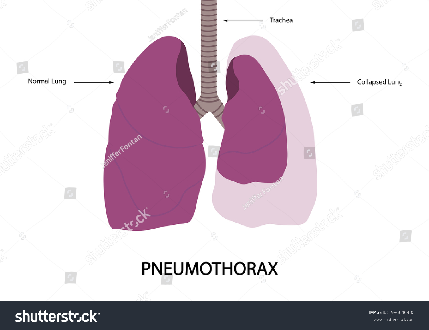 Pneumothorax Illustration Normal Lung Versus Collapsed Stock Illustration 1986646400 Shutterstock 6411